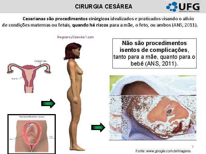 CIRURGIA CESÁREA Cesarianas são procedimentos cirúrgicos idealizados e praticados visando o alívio de condições CIRURGIA CESÁREA Cesarianas são procedimentos cirúrgicos idealizados e praticados visando o alívio de condições