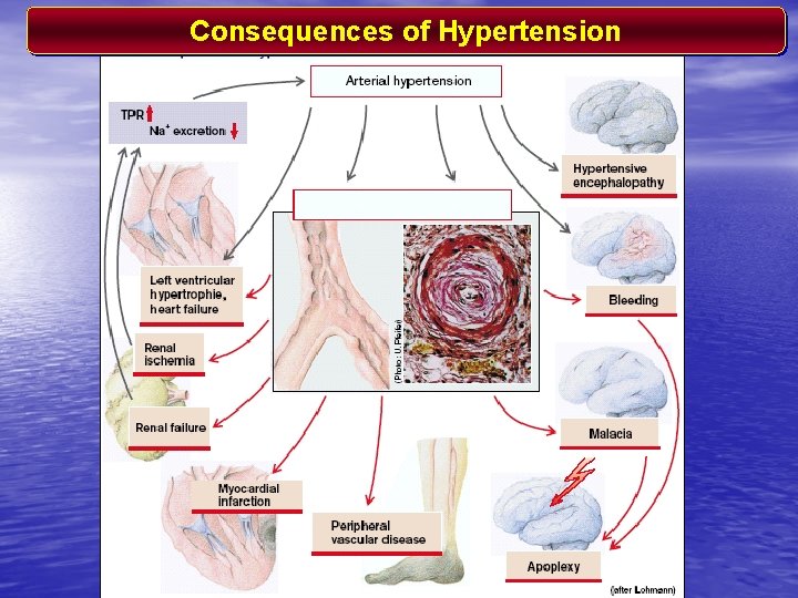 Consequences of Hypertension 