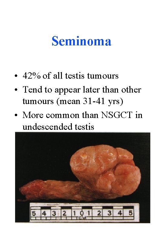 Seminoma • 42% of all testis tumours • Tend to appear later than other