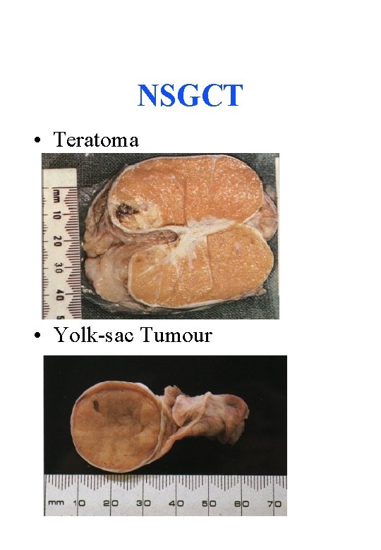 NSGCT • Teratoma • Yolk-sac Tumour 