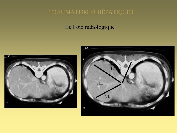 TRAUMATISMES HÉPATIQUES Le Foie radiologique IV a VIII VII II 