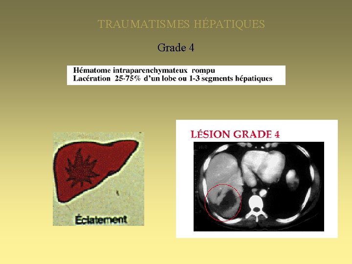TRAUMATISMES HÉPATIQUES Grade 4 