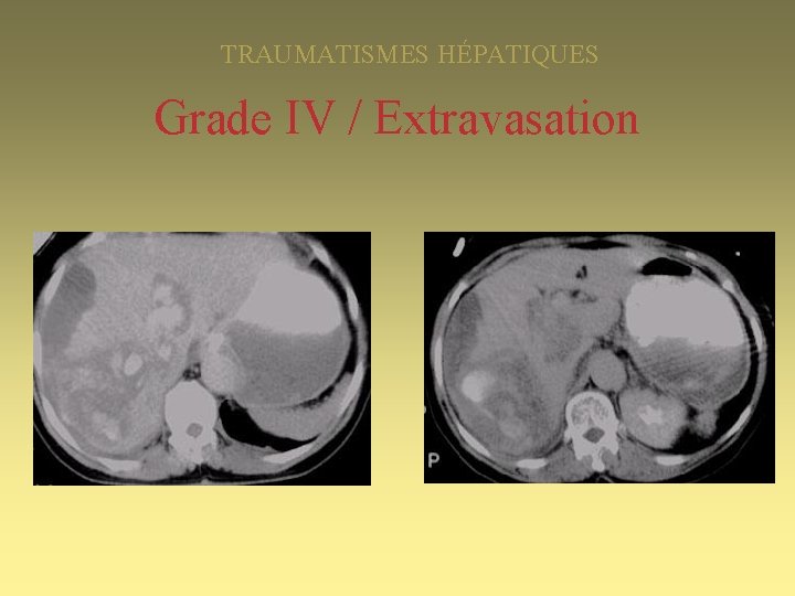 TRAUMATISMES HÉPATIQUES Grade IV / Extravasation 