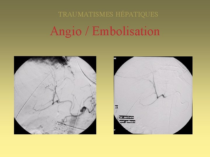 TRAUMATISMES HÉPATIQUES Angio / Embolisation 