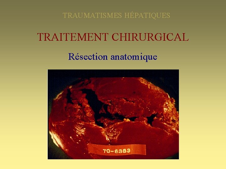 TRAUMATISMES HÉPATIQUES TRAITEMENT CHIRURGICAL Résection anatomique 