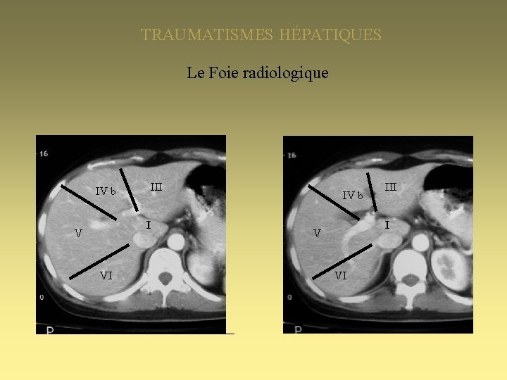 TRAUMATISMES HÉPATIQUES Le Foie radiologique IV b III I V VI 