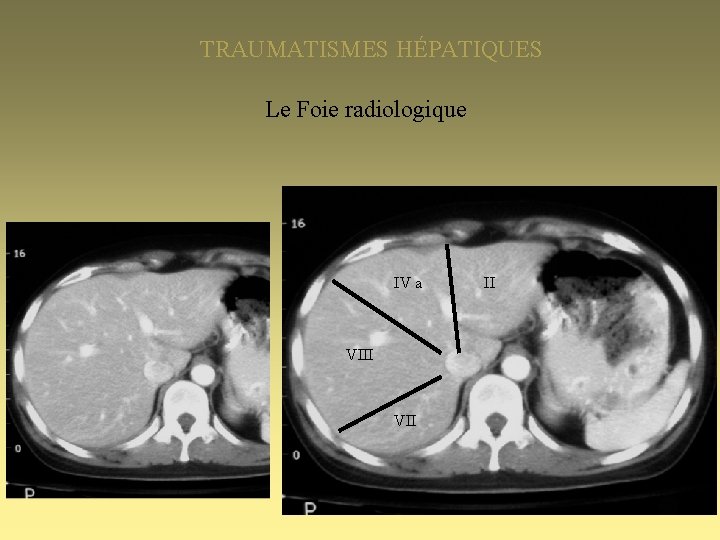 TRAUMATISMES HÉPATIQUES Le Foie radiologique IV a VIII VII II 