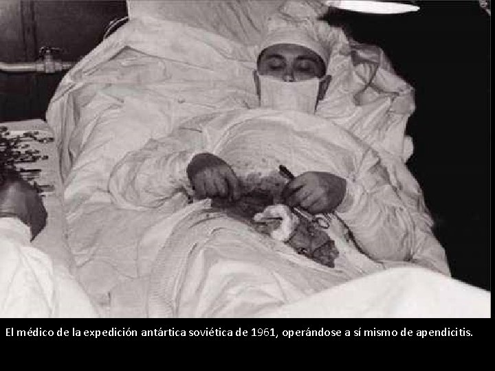 El médico de la expedición antártica soviética de 1961, operándose a sí mismo de