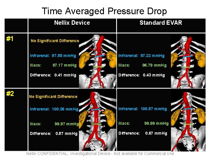 Time Averaged Pressure Drop Nellix Device #1 No Significant Difference Infrarenal: 97. 58 mm.
