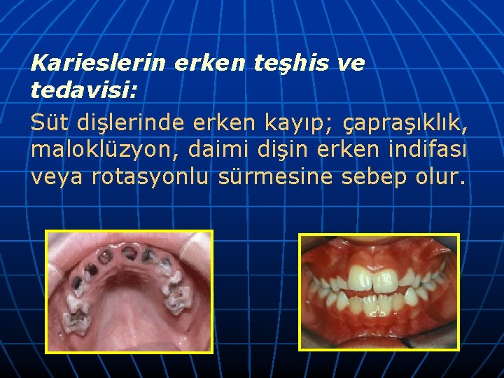 Karieslerin erken teşhis ve tedavisi: Süt dişlerinde erken kayıp; çapraşıklık, maloklüzyon, daimi dişin erken