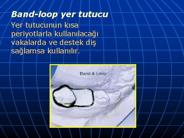 Band-loop yer tutucu Yer tutucunun kısa periyotlarla kullanılacağı vakalarda ve destek diş sağlamsa kullanılır.