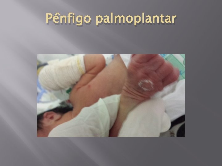 Pênfigo palmoplantar 