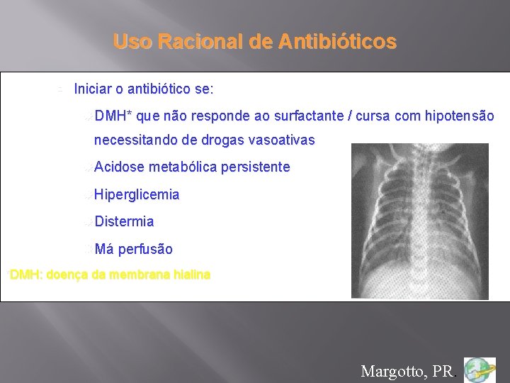Uso Racional de Antibióticos Iniciar o antibiótico se: DMH* que não responde ao surfactante
