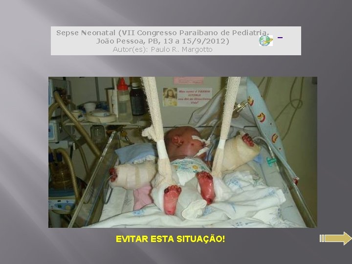 Sepse Neonatal (VII Congresso Paraibano de Pediatria, João Pessoa, PB, 13 a 15/9/2012) Autor(es):