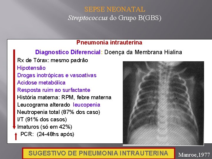 SEPSE NEONATAL Streptococcus do Grupo B(GBS) Pneumonia intrauterina Diagnostico Diferencial: Doença da Membrana Hialina