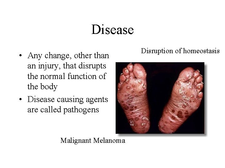 Disease • Any change, other than an injury, that disrupts the normal function of