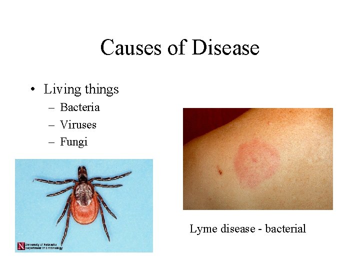 Causes of Disease • Living things – Bacteria – Viruses – Fungi Lyme disease