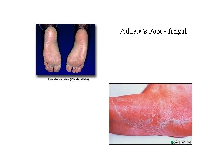 Athlete’s Foot - fungal 