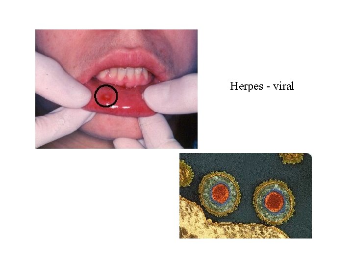 Herpes - viral 