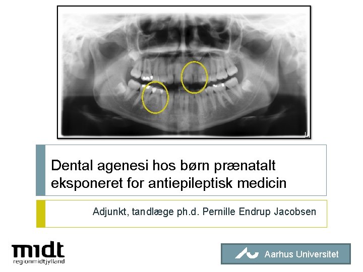 Dental agenesi hos børn prænatalt eksponeret for antiepileptisk medicin Adjunkt, tandlæge ph. d. Pernille