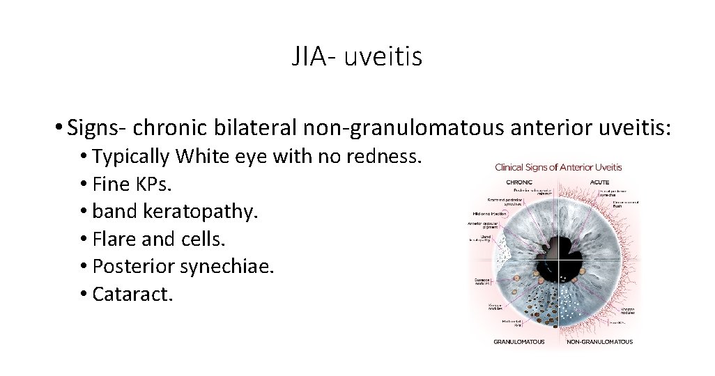 JIA- uveitis • Signs- chronic bilateral non-granulomatous anterior uveitis: • Typically White eye with JIA- uveitis • Signs- chronic bilateral non-granulomatous anterior uveitis: • Typically White eye with
