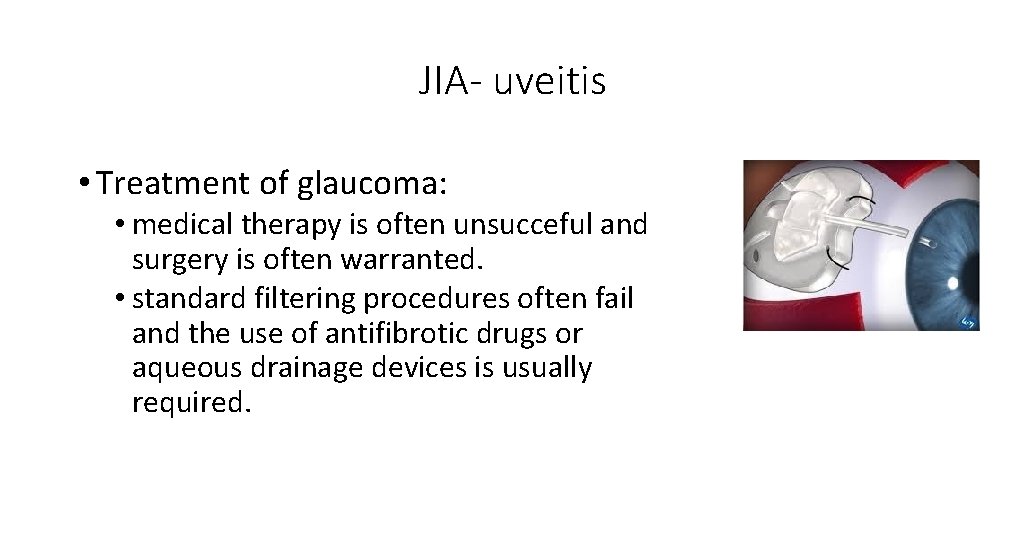 JIA- uveitis • Treatment of glaucoma: • medical therapy is often unsucceful and surgery