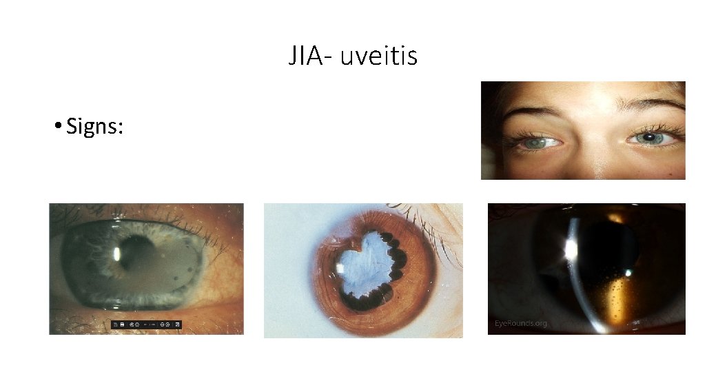 JIA- uveitis • Signs: 