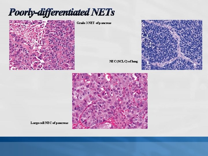 Grade 3 NET of pancreas NEC (SCLC) of lung Large cell NEC of pancreas