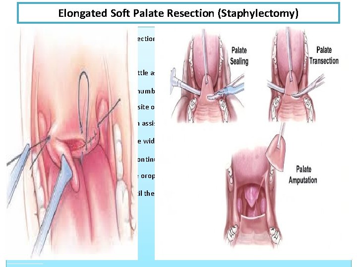 Elongated Soft Palate Resection (Staphylectomy) 1 -Visually mark the site of proposed resection using Elongated Soft Palate Resection (Staphylectomy) 1 -Visually mark the site of proposed resection using