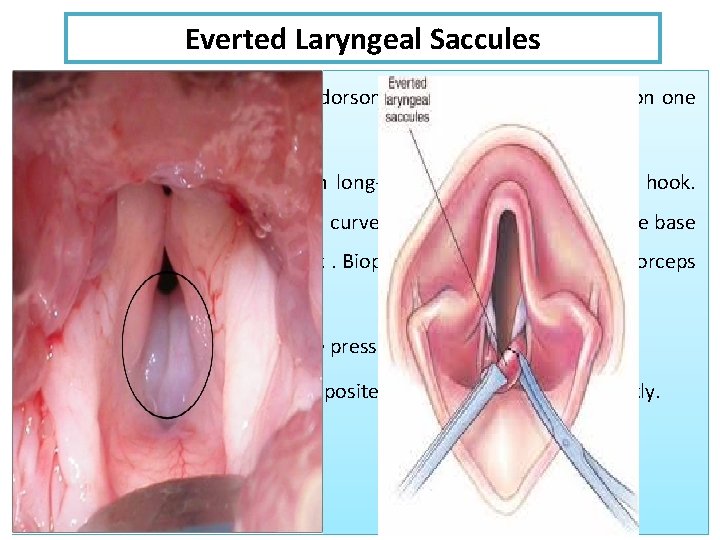 Everted Laryngeal Saccules 1 -Retract the endotracheal tube dorsomedially so that the saccule on Everted Laryngeal Saccules 1 -Retract the endotracheal tube dorsomedially so that the saccule on