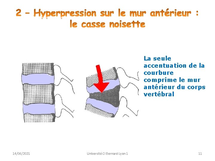 La seule accentuation de la courbure comprime le mur antérieur du corps vertébral 14/06/2021