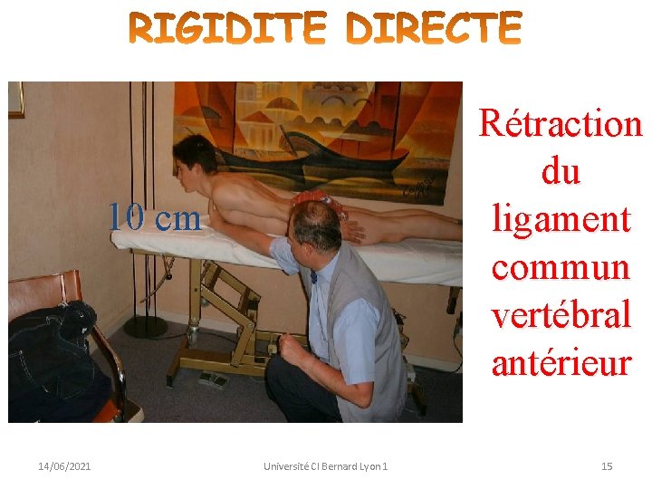 Rétraction du ligament commun vertébral antérieur 10 cm 14/06/2021 Université Cl Bernard Lyon 1