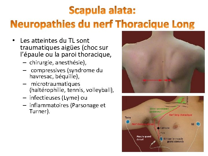  • Les atteintes du TL sont traumatiques aigües (choc sur l’épaule ou la