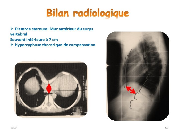 Ø Distance sternum- Mur antérieur du corps vertébral Souvent inférieure à 7 cm Ø