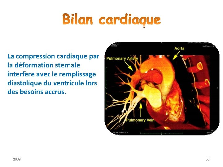 La compression cardiaque par la déformation sternale interfère avec le remplissage diastolique du ventricule