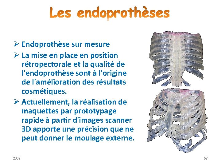 Ø Endoprothèse sur mesure Ø La mise en place en position rétropectorale et la