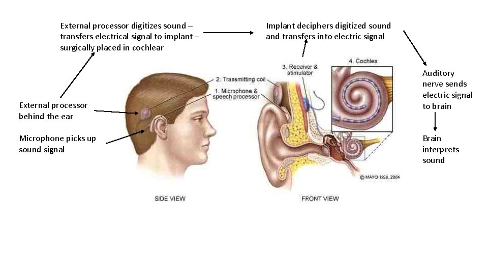 External processor digitizes sound – transfers electrical signal to implant – surgically placed in