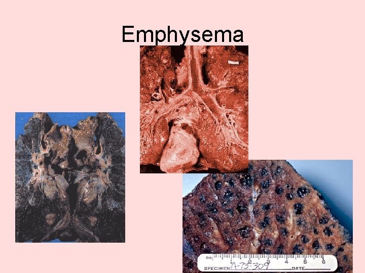 Emphysema 