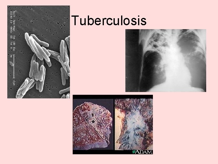 Tuberculosis 