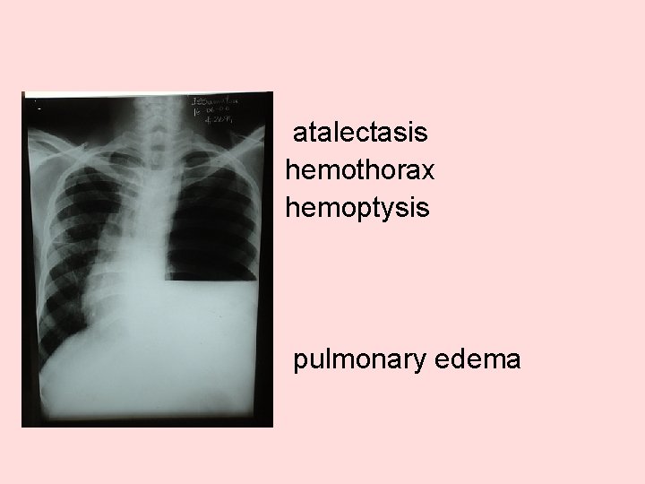  • • atalectasis hemothorax hemoptysis • • pulmonary edema 