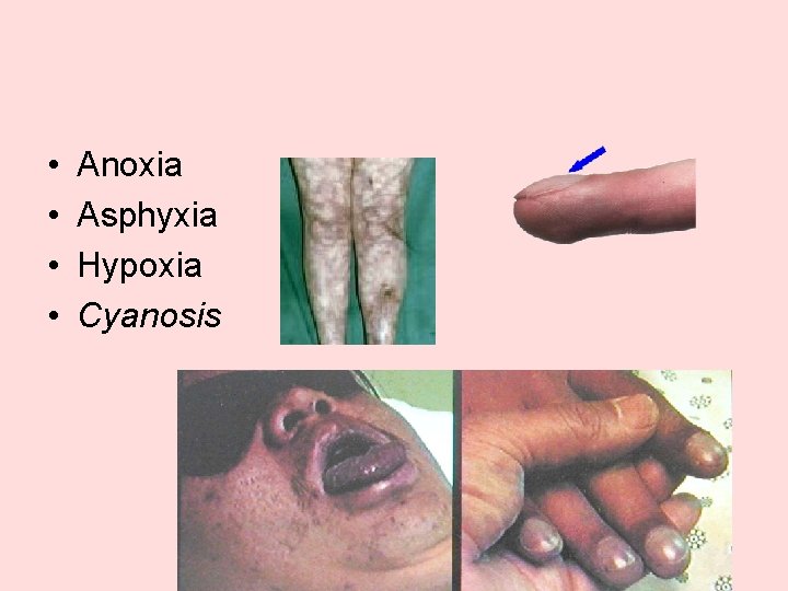  • • Anoxia Asphyxia Hypoxia Cyanosis 