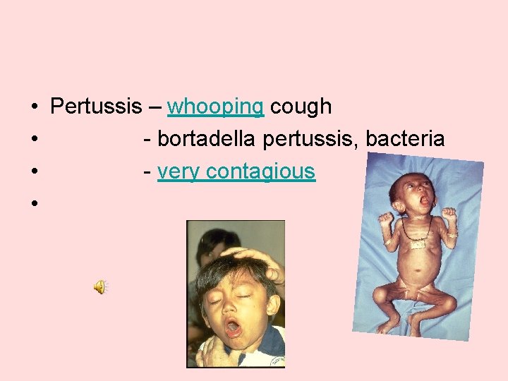  • Pertussis – whooping cough • - bortadella pertussis, bacteria • - very