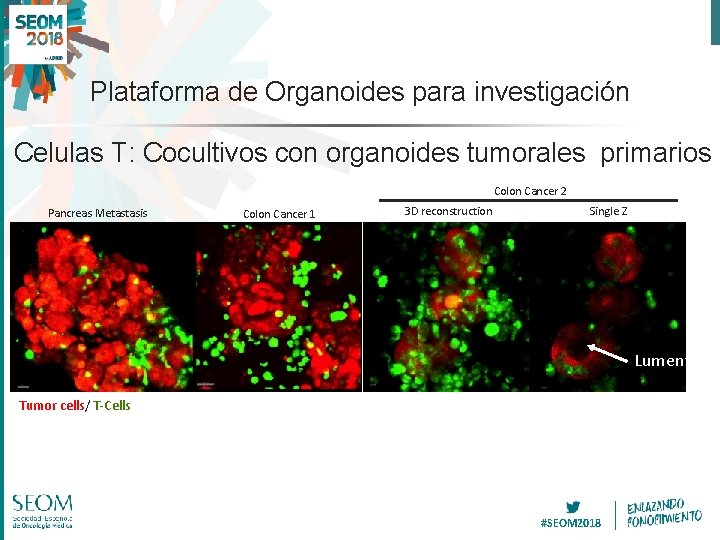 Plataforma de Organoides para investigación Celulas T: Cocultivos con organoides tumorales primarios Colon Cancer