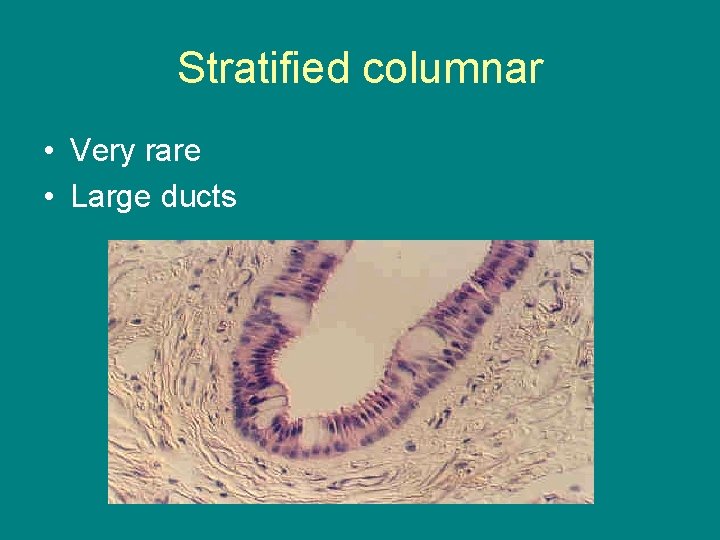 Stratified columnar • Very rare • Large ducts 
