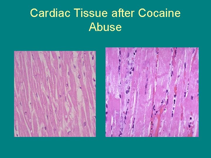 Cardiac Tissue after Cocaine Abuse 