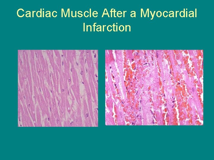 Cardiac Muscle After a Myocardial Infarction 