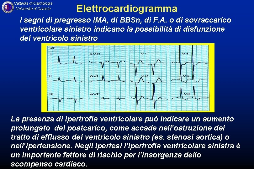 Cattedra di Cardiologia Università di Catania Elettrocardiogramma I segni di pregresso IMA, di BBSn,