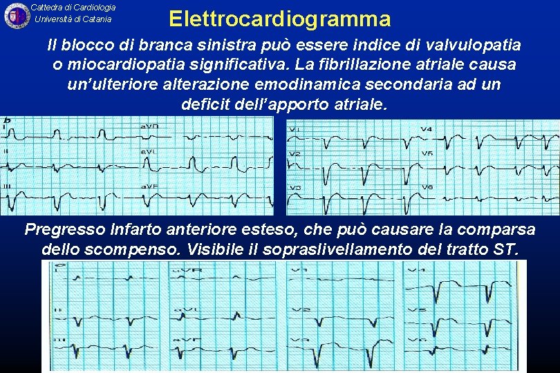 Cattedra di Cardiologia Università di Catania Elettrocardiogramma Il blocco di branca sinistra può essere
