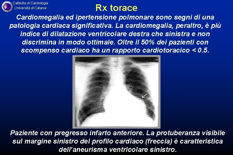 Cattedra di Cardiologia Università di Catania Rx torace Cardiomegalia ed ipertensione polmonare sono segni