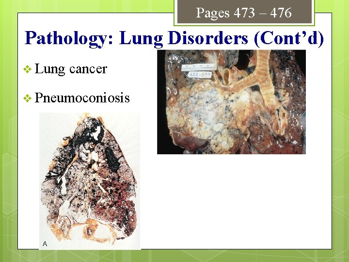 Pages 473 – 476 Pathology: Lung Disorders (Cont’d) v Lung cancer v Pneumoconiosis 